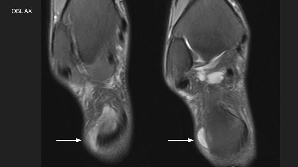 Figure 5 for case retrocalcaneal bursa ( RID3217 )